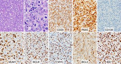 Case Report: Phenotypic Switch in High-Grade B-Cell Lymphoma With MYC and BCL6 Rearrangements: A Potential Mechanism of Therapeutic Resistance in Lymphoma?